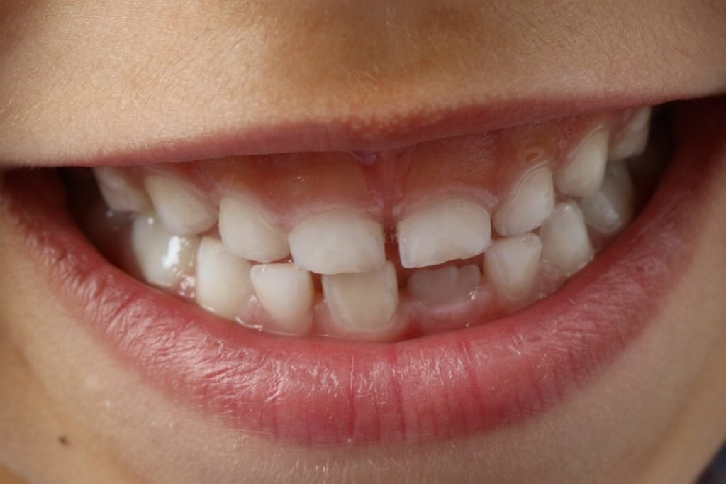 Sonrisa de un niño afectada por caries inicial 