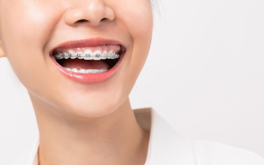 cuidado de los brackets