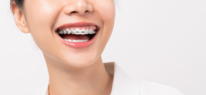 cuidado de los brackets
