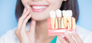 Implantes dentales
